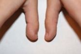 180px-clubbed_thumb_2.jpg